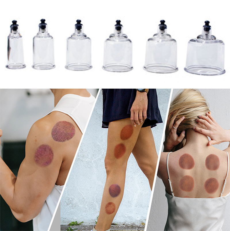 17cans Cupping Therapy Set Ven - Cupping Therapy Set 评论和价格